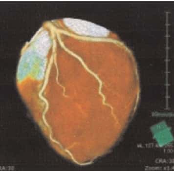 冠動脈の3D画像