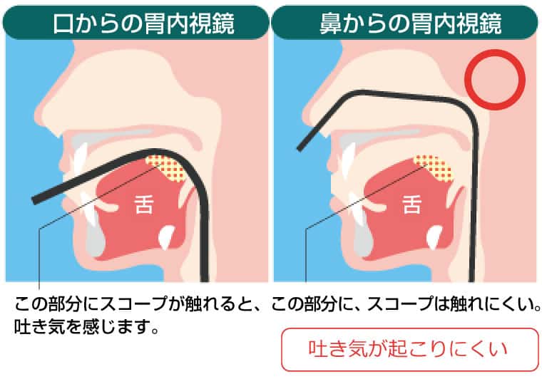 口から入れる胃内視鏡と鼻から入れる胃内視鏡の違い