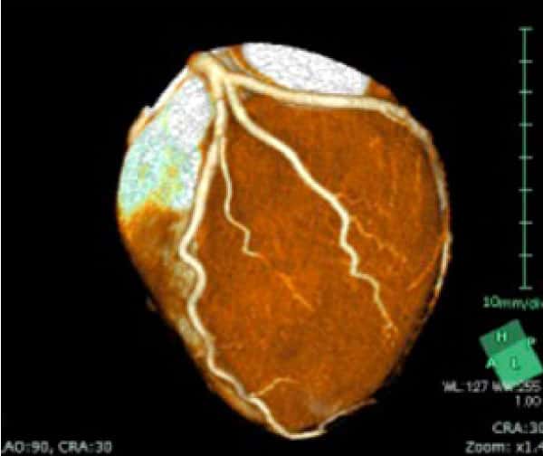 当院で撮影した冠動脈CT画像